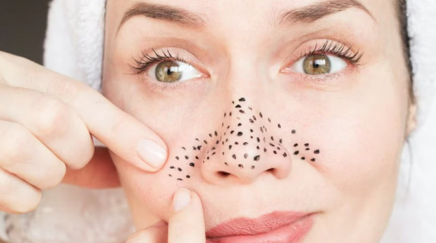 Is It Okay to Remove Blackheads at Home?