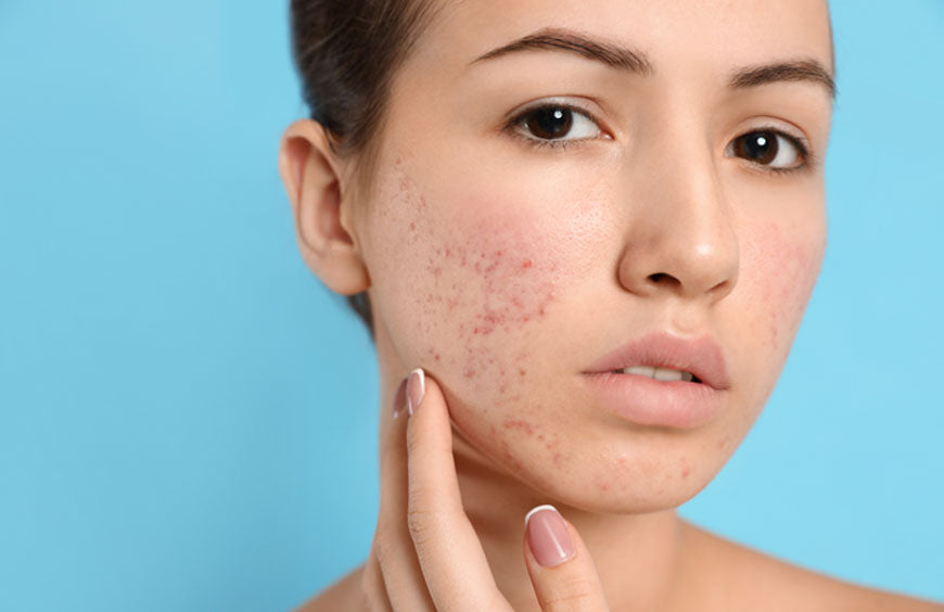 Is it Healthy to Pop Your Pimples?