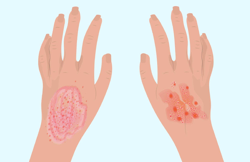 What Is Eczema?
