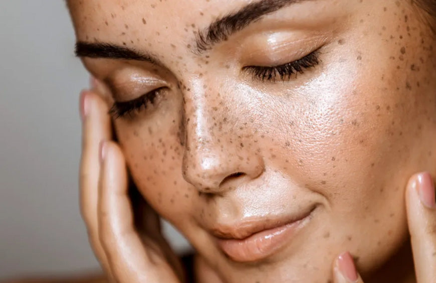 How to Prevent Freckles From Getting Darker