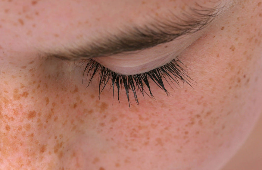 What Causes Freckles on Skin?
